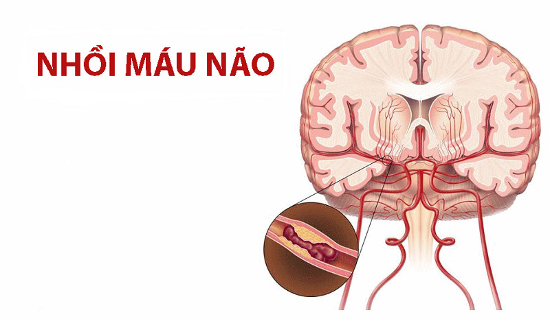 Đột Quỵ Nhồi Máu Não (Thiếu Máu Não): Những Điều Bạn Cần Biết Đột Quỵ Nhồi Máu Não (Thiếu Máu Não): Những Điều Bạn Cần Biết